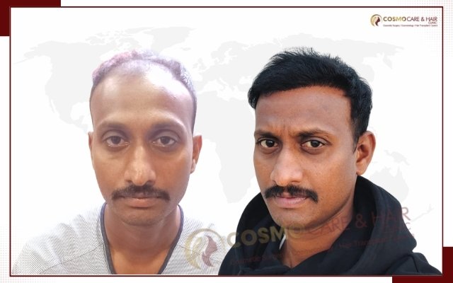 Before hair transplant, receding hairline